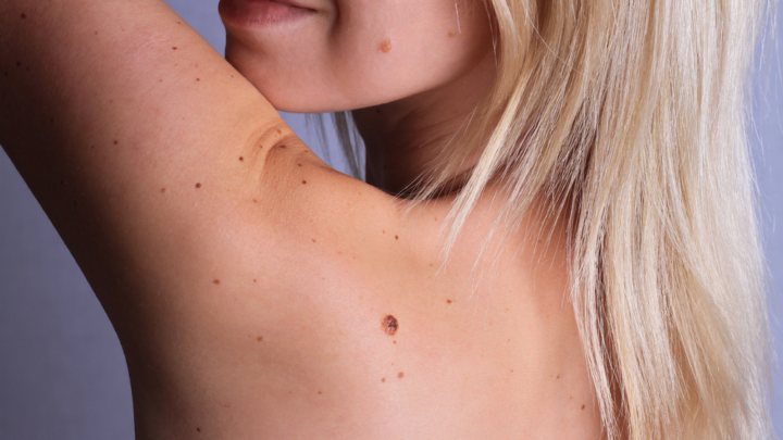 What Are The Moles in Our Body Telling Us?