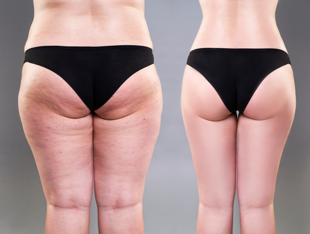 3D laser lipolysis