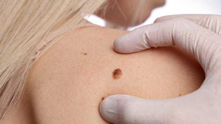 The Birthmark Itches | Is that Dangerous?