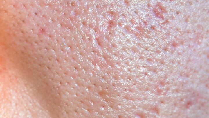 Reducing Large Pores: The Best Tips and Tricks