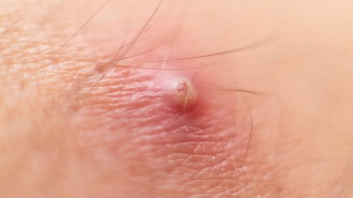 How to Treat Inflamed Pimples