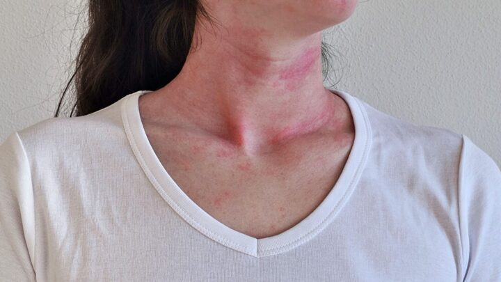 Allergic Reaction: What Helps in an Emergency?