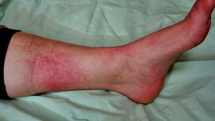 Erysipelas: Causes, Symptoms and Treatment