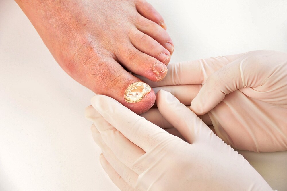 Nail Fungus: This Helps Against The Stubborn Fungal Pathogen!