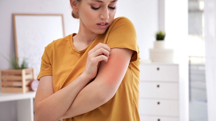 Nickel Allergy: Symptoms and Treatment