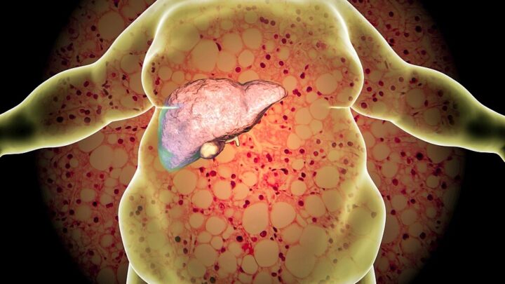 Nutrition for Fatty Liver: 4 Important Rules