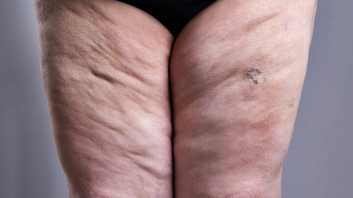 Recognizing Lipedema: 4 Potential Symptoms