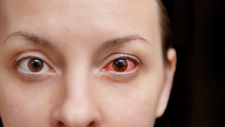 Pink Eye (Conjunctivitis): 3 Home Remedies That Help