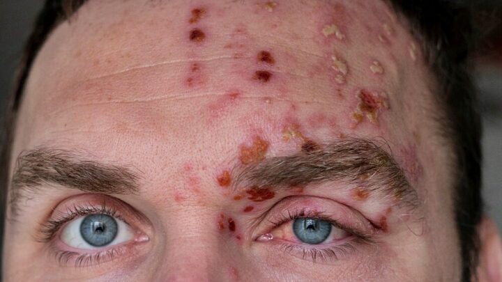 Eye Herpes: What Really Helps