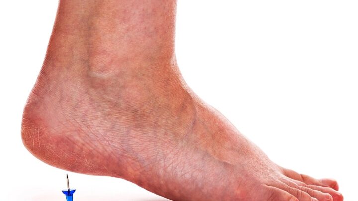Heel Spur: Causes and Treatment