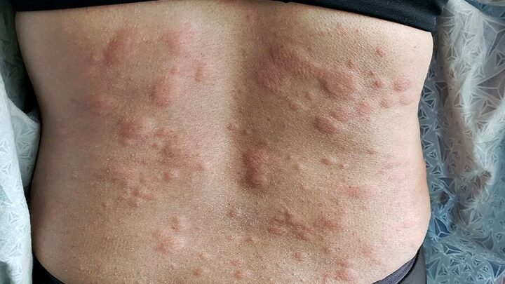 Home Remedies for Hives: What Really Helps?