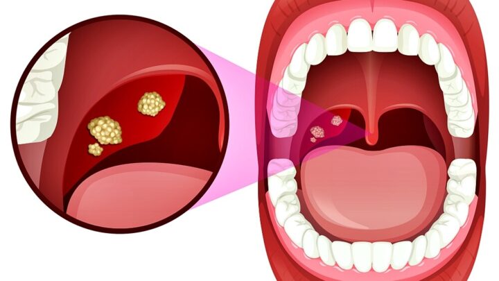 Home Remedies for Tonsillitis: 8 Useful Tips
