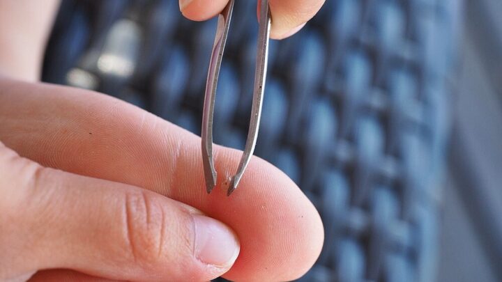 How to Remove a Splinter: First Aid and Tips