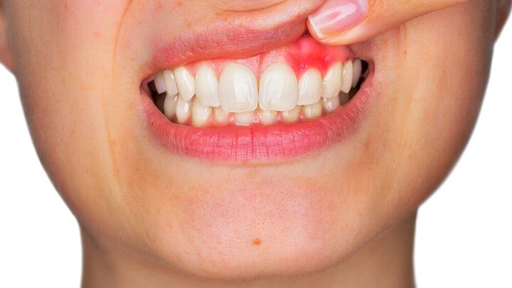 Home Remedies Against Inflamed Gums: 5 Practical Tips!