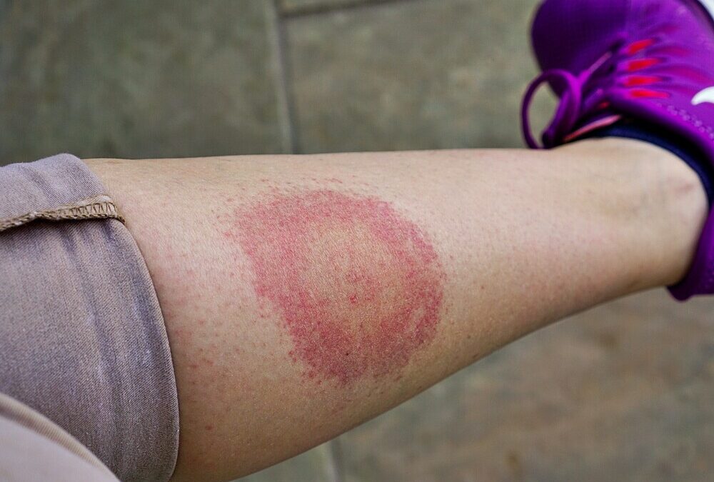 Lyme Disease Symptoms: That’s How You Recognize Them