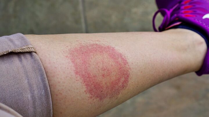 Lyme Disease Symptoms: That’s How You Recognize Them