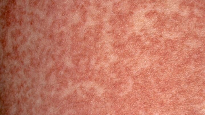 Penicillin Allergy: Symptoms and Treatment