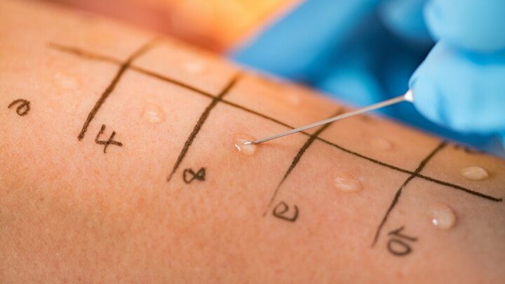 Prick Test (Allergy Testing): Test Procedure and Costs