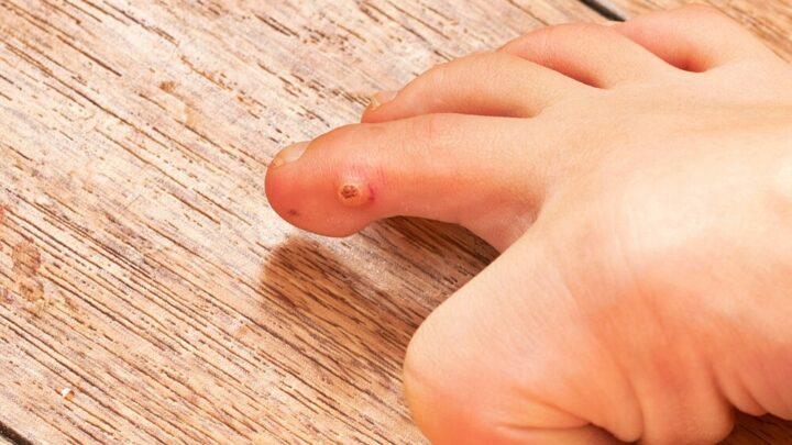 Removing a Plantar Wart: These Methods Help