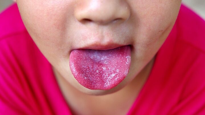 Scarlet Fever: Symptoms, Causes and Treatment