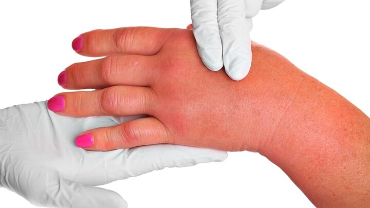 Swollen Hands During Pregnancy: What Helps?