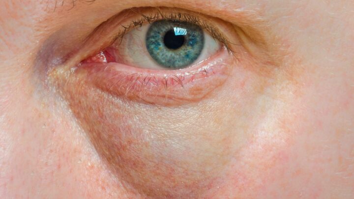 Fighting Bags Under The Eyes: You Have to Know That