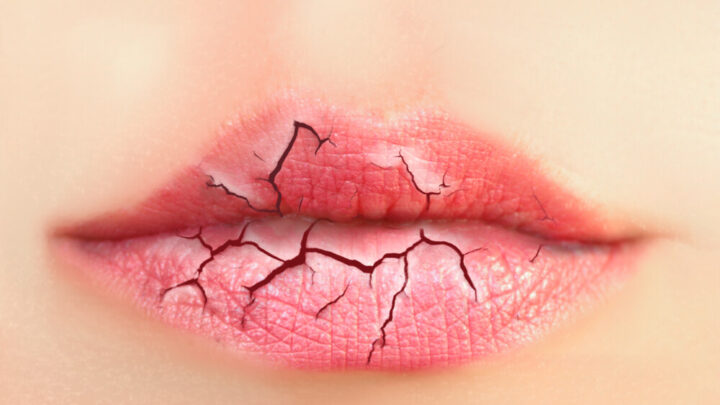 Chapped Lips: Causes and Home Remedies