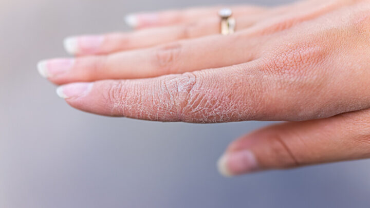Dry & Cracked Hands: Causes and Treatment