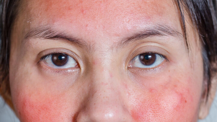 Facial Rash: Causes and Tips