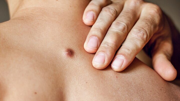 Fibroma Removal: This is How You Get Rid of The Skin Nodes