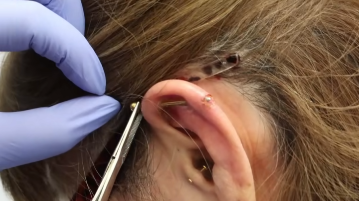 Infected Piercing: That’s How You Take Care of It!