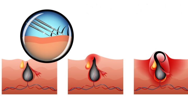 How to Get Rid of Ingrown Hair