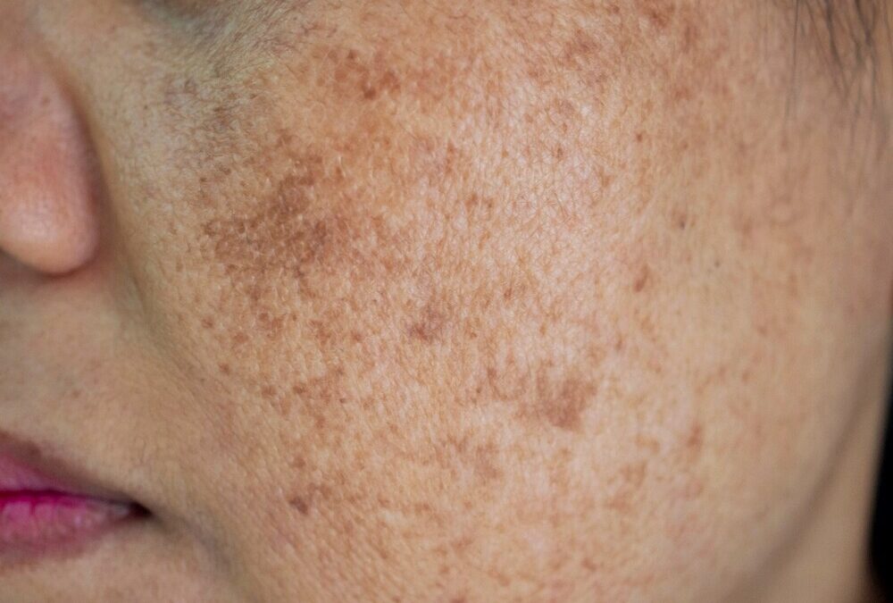 Home Remedies for Pigmentation: How to Remove Dark Spots
