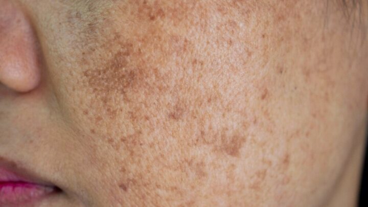 Home Remedies for Pigmentation: How to Remove Dark Spots