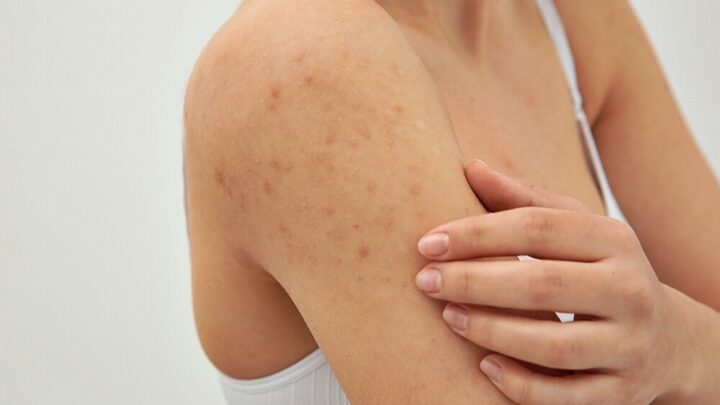 Pimples on The Upper Arm: This Helps!