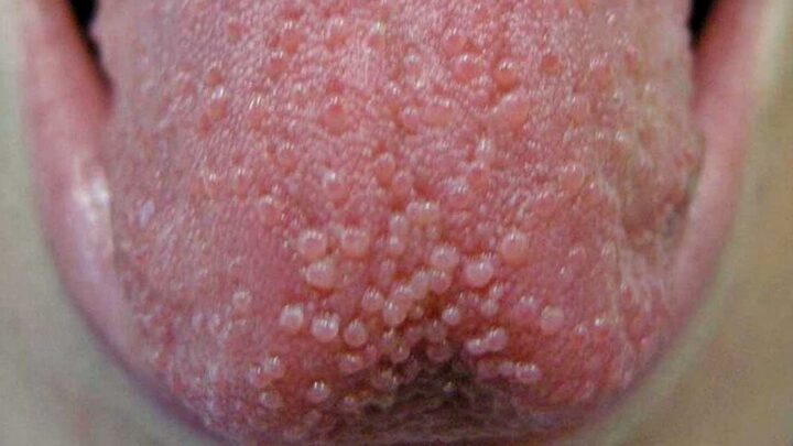 Tongue Bumps: How to Get Rid of Them