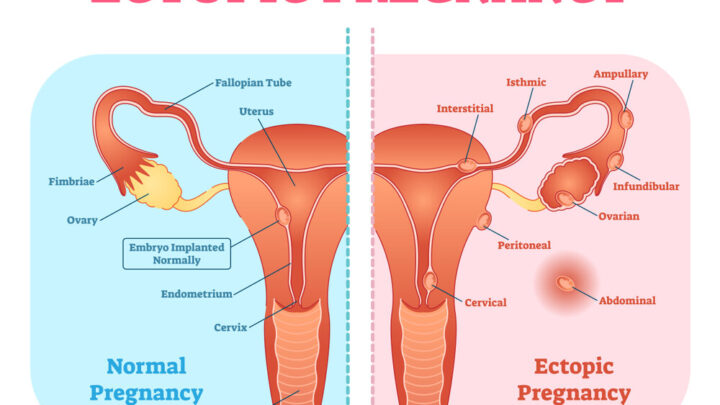 Ectopic Pregnancy: Symptoms and Treatment