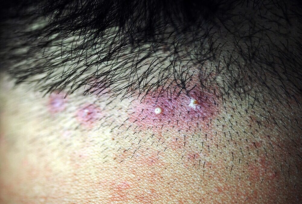 How to Treat a Pimple on Your Scalp