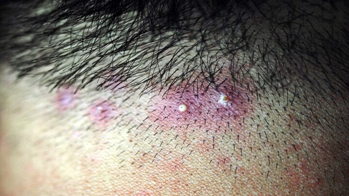 How to Treat a Pimple on Your Scalp