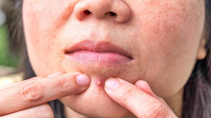 Should You Pop a Pimple? 6 Important Rules