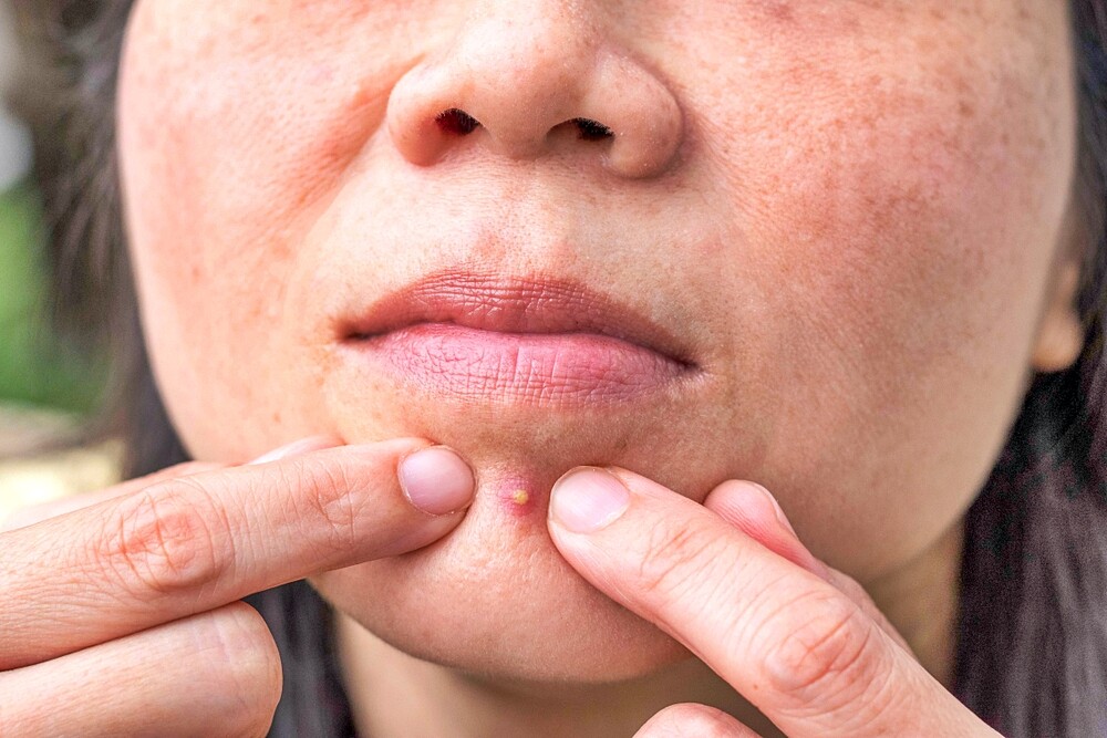pimple popping jobs Why are 'we' so obsessed with popping pimples?