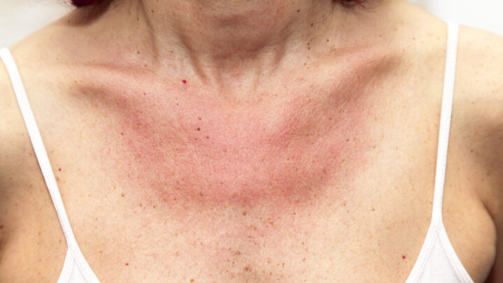 Preventing Sun Allergy: 4 Practical Tips