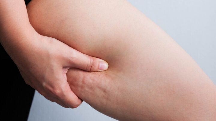 Do You Know This Miracle Cure for Cellulite?
