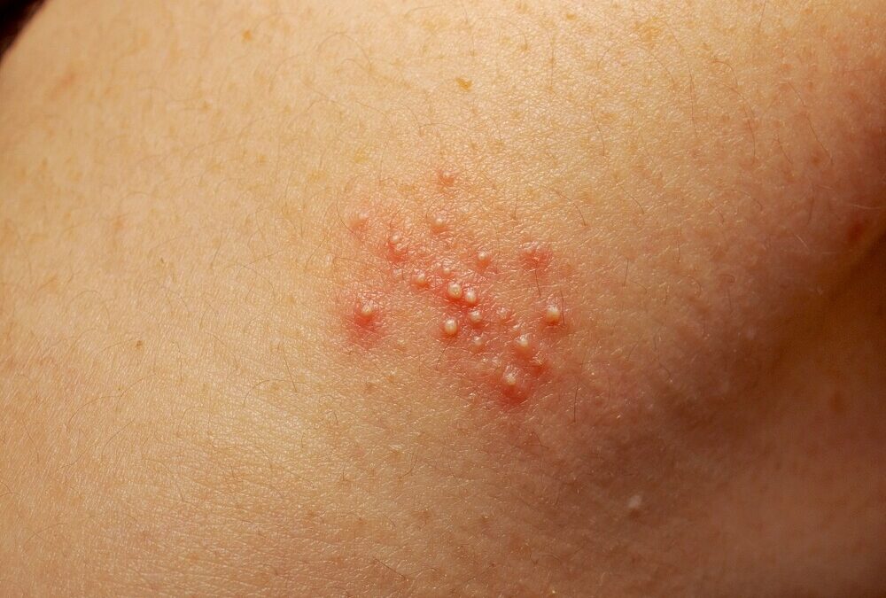 How to Get Rid of Prickly Heat (Heat Rash)