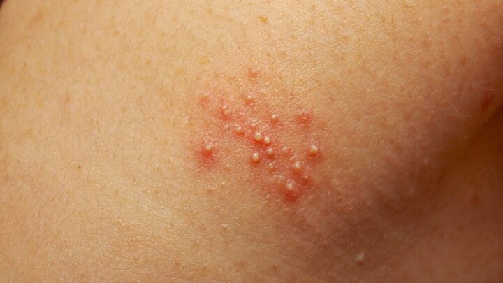 How to Get Rid of Prickly Heat (Heat Rash)