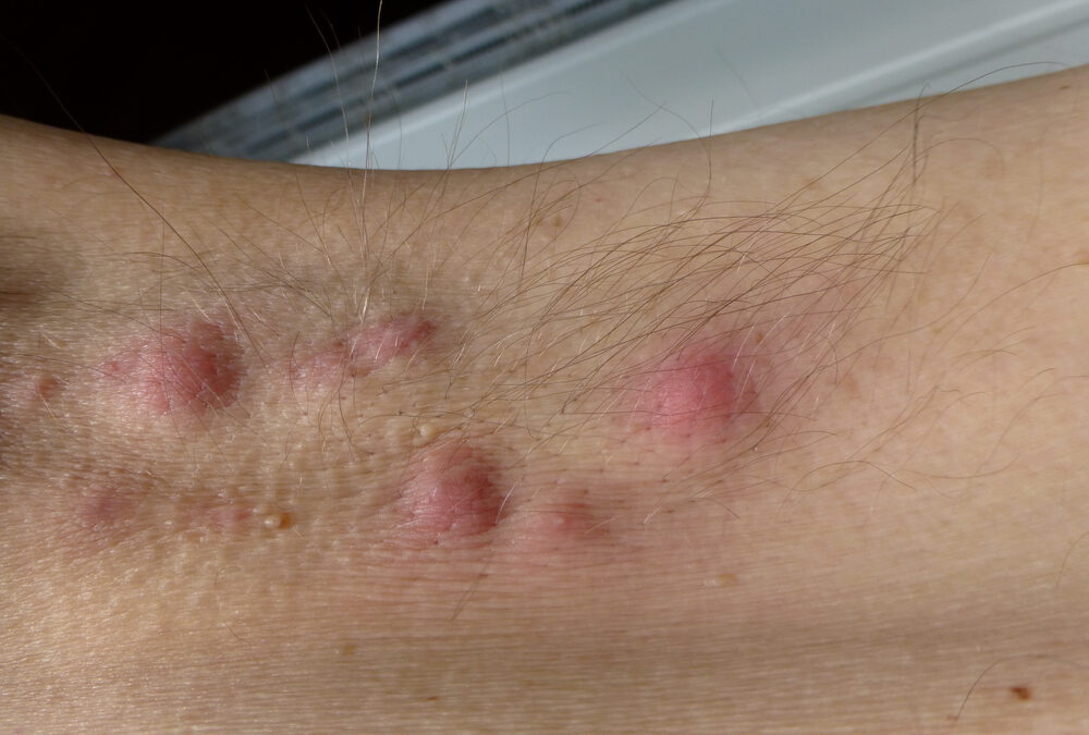 Acne Inversa (Hidradenitis Suppurativa): Definition, Causes and Treatment