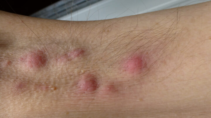 Acne Inversa (Hidradenitis Suppurativa): Definition, Causes and Treatment