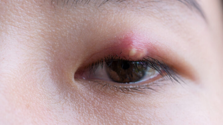 Everything You Need to Know About Styes