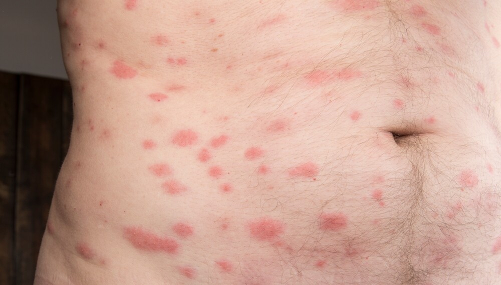 How to Figure out Which Insect Stung You 6 fleabites