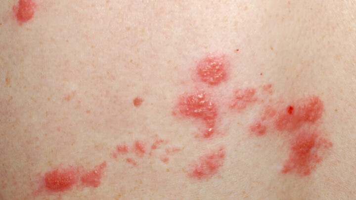 Shingles (Herpes Zoster): Symptoms, Treatment & Prevention
